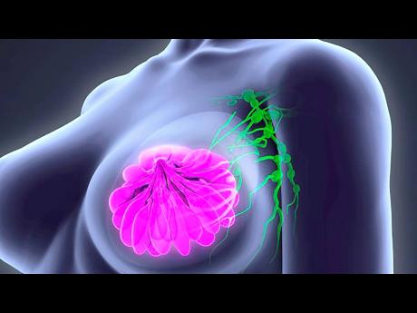 Breast cancer is the leading cause of cancer deaths in Jamaican women.