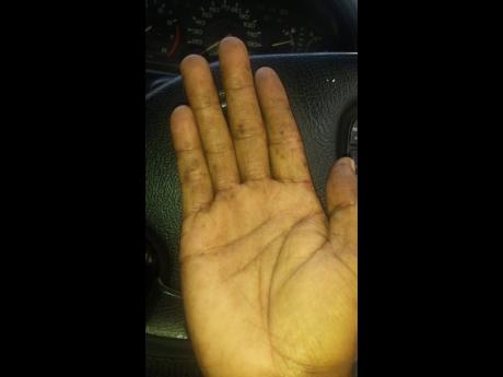 3. Nearly a month later, his hands are almost healed after taking a nurse’s advice to apply home-made castor oil to his them regulary.