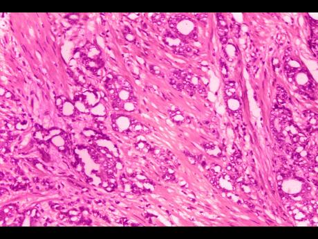 This 1974 microscope image made available by the Centers for Disease Control and Prevention shows changes in cells indicative of adenocarcinoma of the prostate. 