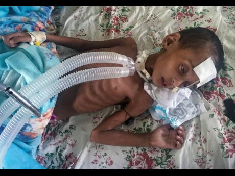 Rahwa Mehari, four, who first suffered from malnutrition, according to her father, and medical records show, then developed a cerebral tuberculoma, is being treated at the Ayder Referral Hospital in Mekele, in the Tigray region of northern Ethiopia.