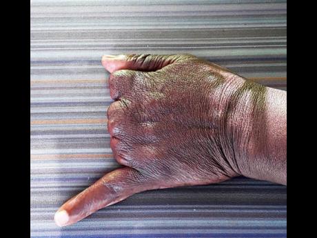 Deslyn Gordon, 69, lost three of her fingers in a machete attack by Kevin Hollingsworth in Comfort, Manchester, 10 years ago. Hollingsworth committed suicide shortly after the attack. 
