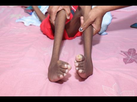 An image of the legs of nine-year-old Devonte who was diagnosed with cerebral palsy.
