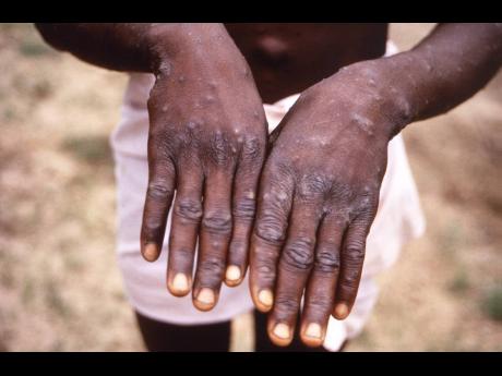 Credit: AP This 1997 image provided by the CDC depicts the dorsal surfaces of the hands of a monkeypox case patient, who was displaying the appearance of the characteristic rash during its recuperative stage.
