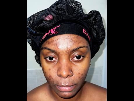 Shantol Vassell shows her skin before using her own skin care products. 