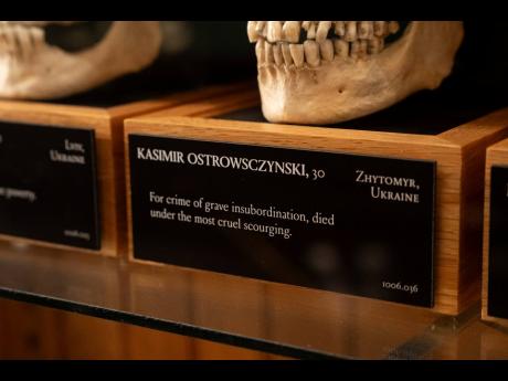 The skull of Kasimir Ostrowsczynski displayed at the Mütter Museum.